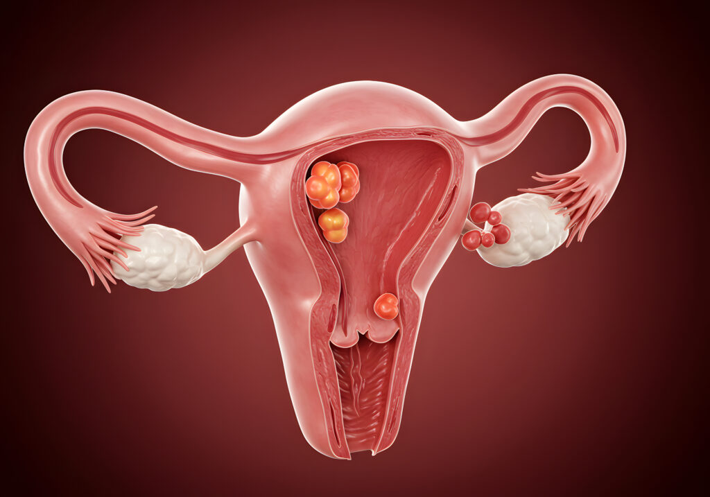 ilustração de útero com miomas submucosos