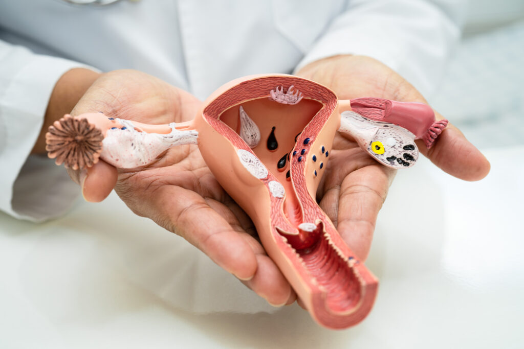 modelo uterino com diversas causas de sangramento uterino anormal